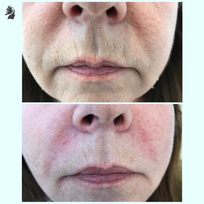 Nasolabial Folds — What Are They and How Can They Be Treated?